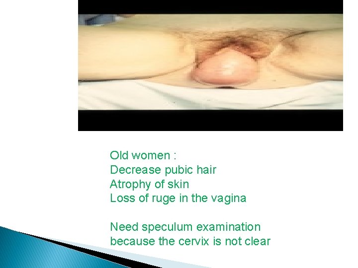 Old women : Decrease pubic hair Atrophy of skin Loss of ruge in the