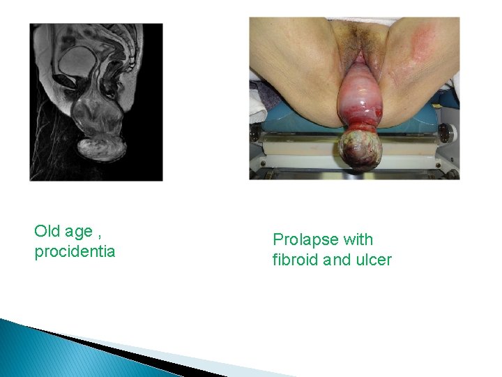 Old age , procidentia Prolapse with fibroid and ulcer 