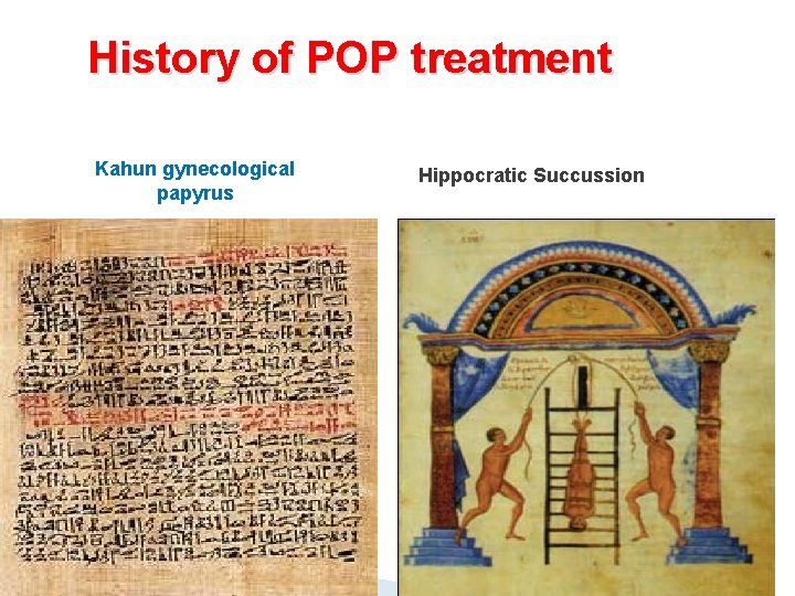 History of POP treatment Kahun gynecological papyrus Hippocratic Succussion 