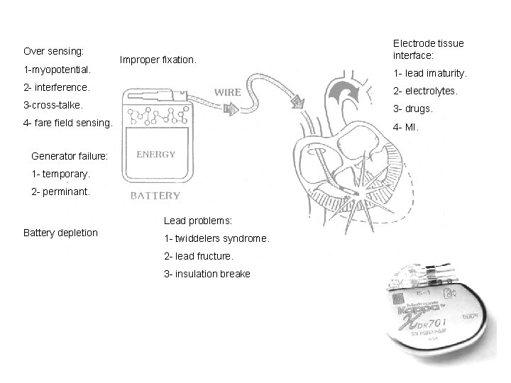 Over sensing: 1 -myopotential. Improper fixation. Electrode tissue interface: 1 - lead imaturity. 2