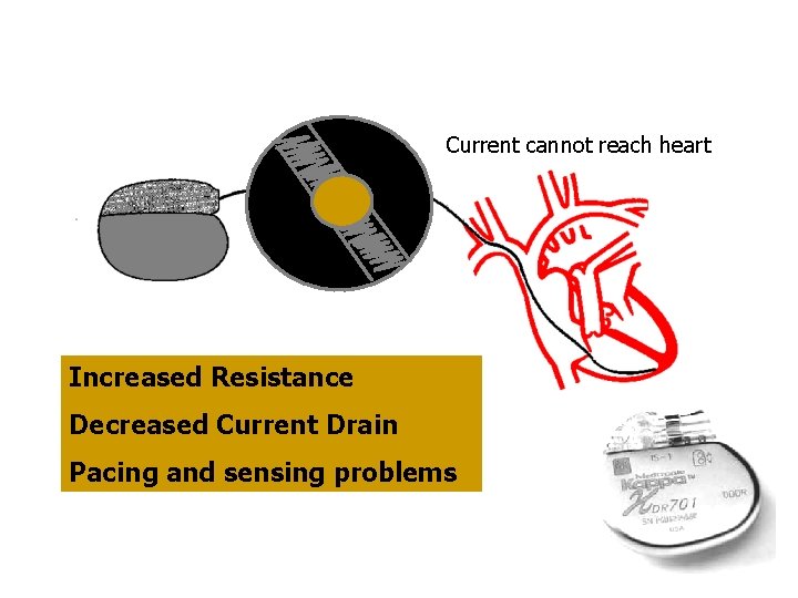 Current cannot reach heart Increased Resistance Decreased Current Drain Pacing and sensing problems 