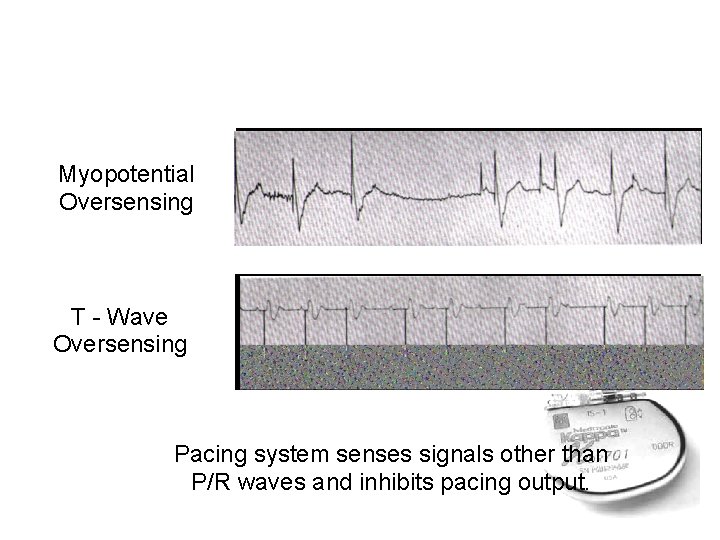 Myopotential Oversensing T - Wave Oversensing Pacing system senses signals other than P/R waves