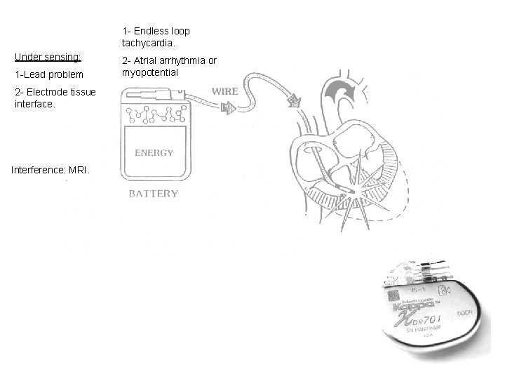 1 - Endless loop tachycardia. Under sensing: 1 -Lead problem 2 - Electrode tissue
