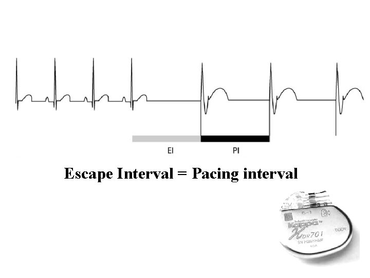 Escape Interval = Pacing interval 