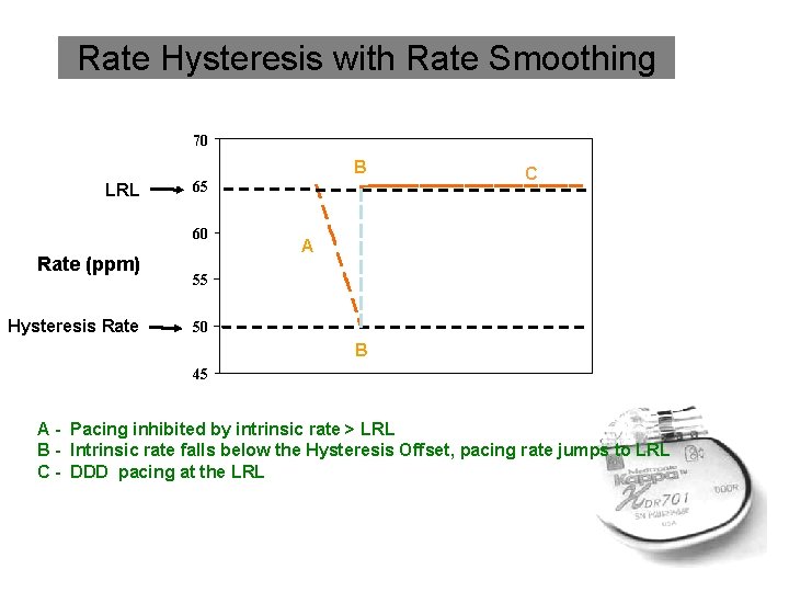 Rate Hysteresis with Rate Smoothing 70 B LRL 65 60 Rate (ppm) Hysteresis Rate
