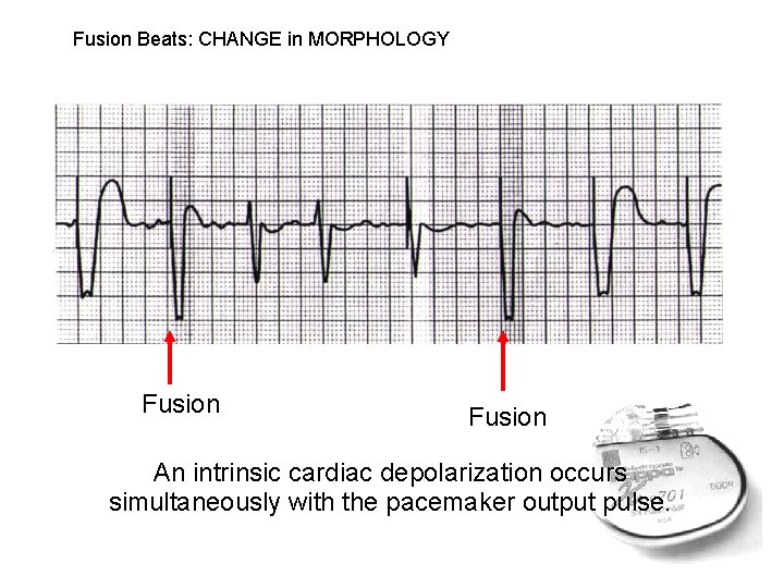 Fusion Beats: CHANGE in MORPHOLOGY Fusion An intrinsic cardiac depolarization occurs simultaneously with the