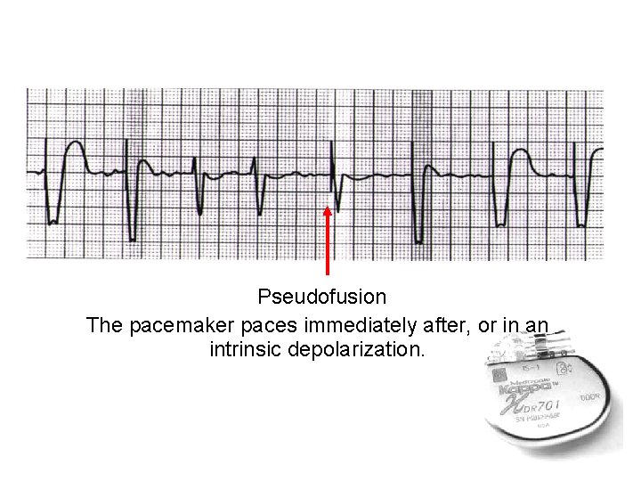 Pseudofusion The pacemaker paces immediately after, or in an intrinsic depolarization. 