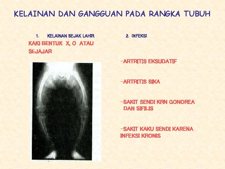 KELAINAN DAN GANGGUAN PADA RANGKA TUBUH 1. KELAINAN SEJAK LAHIR 2. INFEKSI KAKI BENTUK