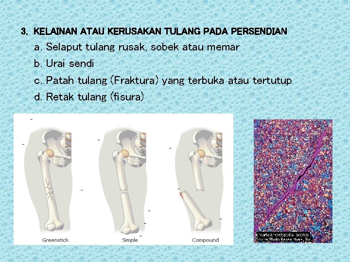 3. KELAINAN ATAU KERUSAKAN TULANG PADA PERSENDIAN a. Selaput tulang rusak, sobek atau memar