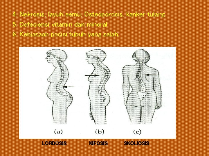 4. Nekrosis, layuh semu, Osteoporosis, kanker tulang 5. Defesiensi vitamin dan mineral 6. Kebiasaan