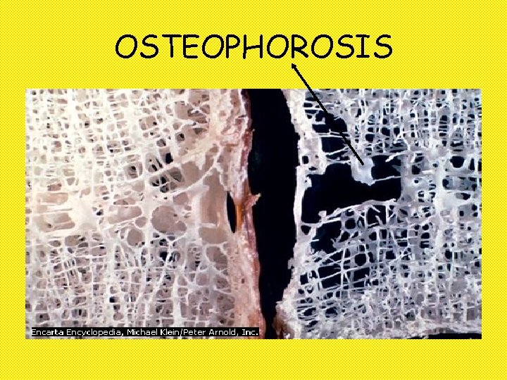 OSTEOPHOROSIS 