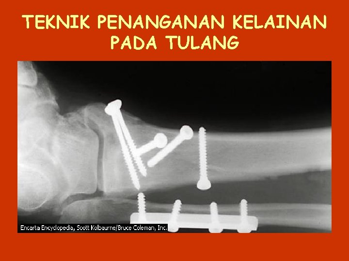 TEKNIK PENANGANAN KELAINAN PADA TULANG 