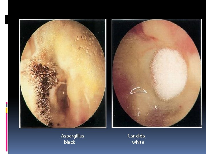 Aspergillus black Candida white 