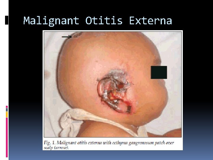 Malignant Otitis Externa 