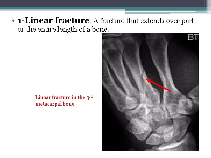  • 1 -Linear fracture: A fracture that extends over part or the entire