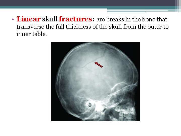  • Linear skull fractures: are breaks in the bone that transverse the full