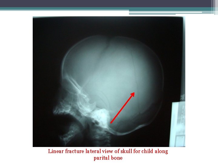 Linear fracture lateral view of skull for child along parital bone 