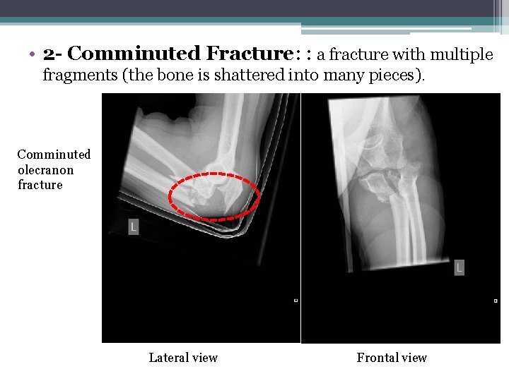  • 2 - Comminuted Fracture: : a fracture with multiple fragments (the bone