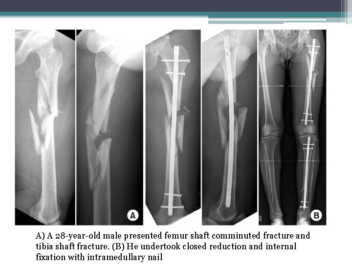 A) A 28 -year-old male presented femur shaft comminuted fracture and tibia shaft fracture.