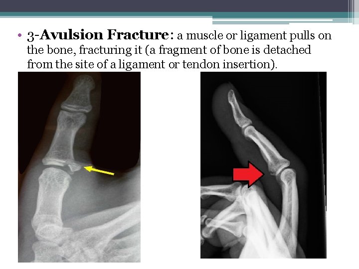  • 3 -Avulsion Fracture: a muscle or ligament pulls on the bone, fracturing