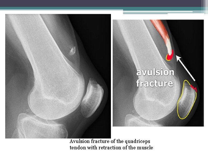 Avulsion fracture of the quadriceps tendon with retraction of the muscle 