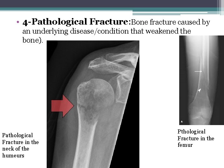  • 4 -Pathological Fracture: Bone fracture caused by an underlying disease/condition that weakened