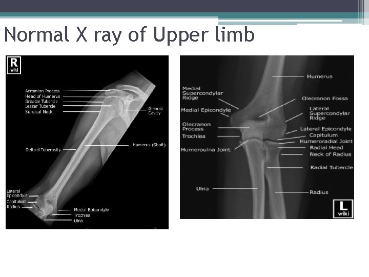 Normal X ray of Upper limb 