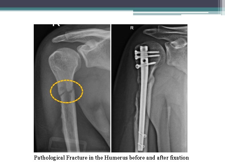 Pathological Fracture in the Humerus before and after fixation 