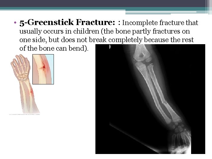  • 5 -Greenstick Fracture: : Incomplete fracture that usually occurs in children (the