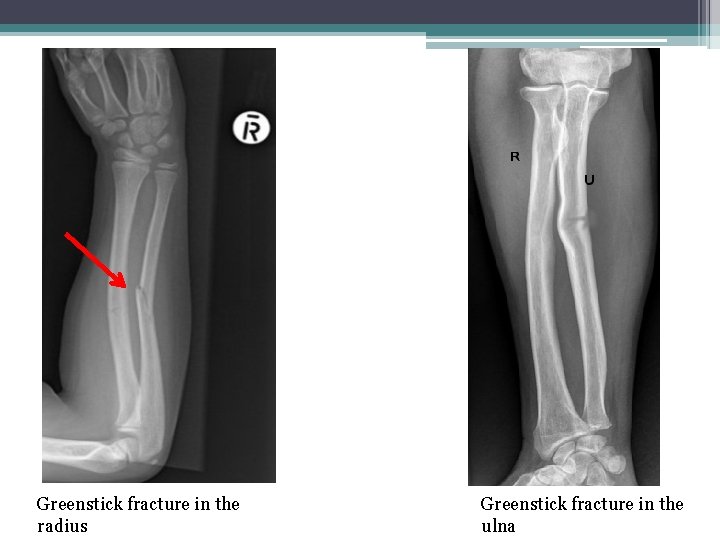 Greenstick fracture in the radius Greenstick fracture in the ulna 