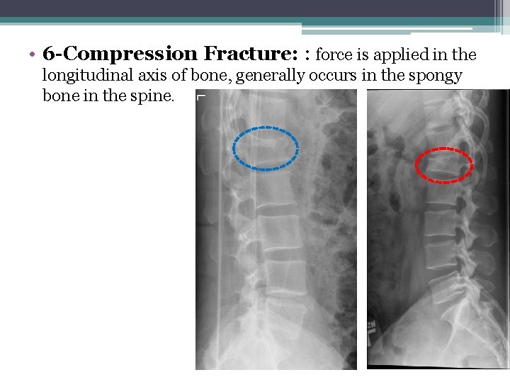  • 6 -Compression Fracture: : force is applied in the longitudinal axis of