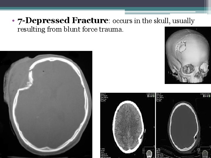  • 7 -Depressed Fracture: occurs in the skull, usually resulting from blunt force