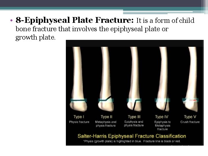  • 8 -Epiphyseal Plate Fracture: It is a form of child bone fracture