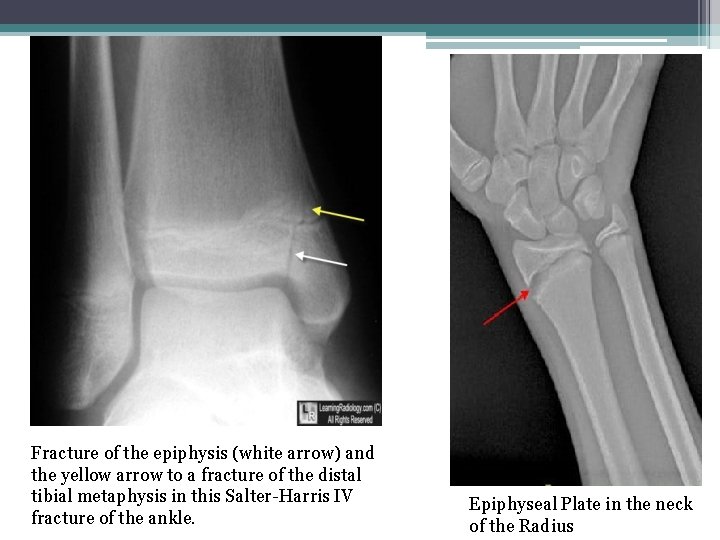 Fracture of the epiphysis (white arrow) and the yellow arrow to a fracture of