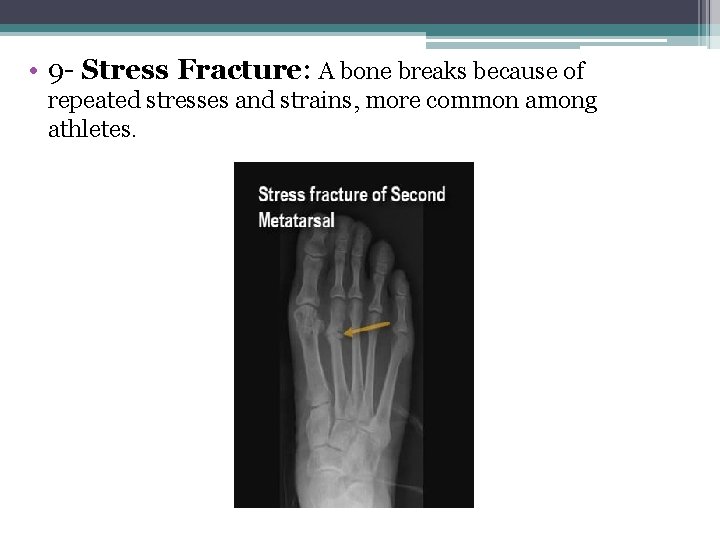  • 9 - Stress Fracture: A bone breaks because of repeated stresses and