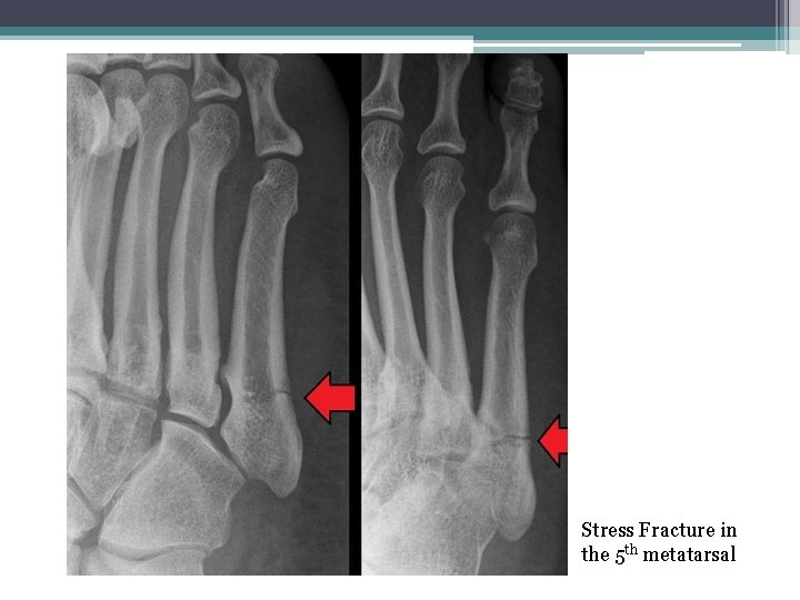 Stress Fracture in the 5 th metatarsal 