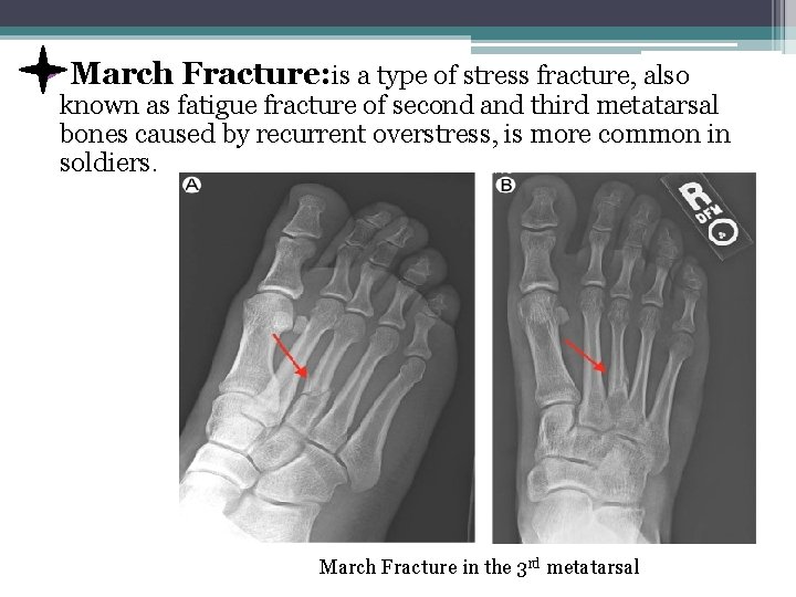 Ø March Fracture: is a type of stress fracture, also known as fatigue fracture