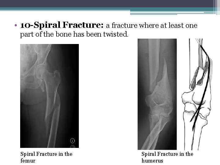  • 10 -Spiral Fracture: a fracture where at least one part of the