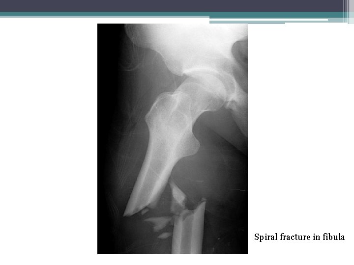 Spiral fracture in fibula 