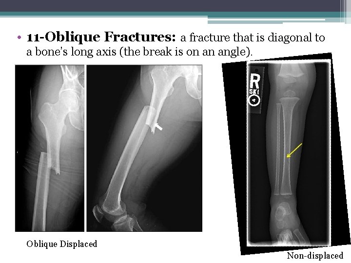  • 11 -Oblique Fractures: a fracture that is diagonal to a bone’s long