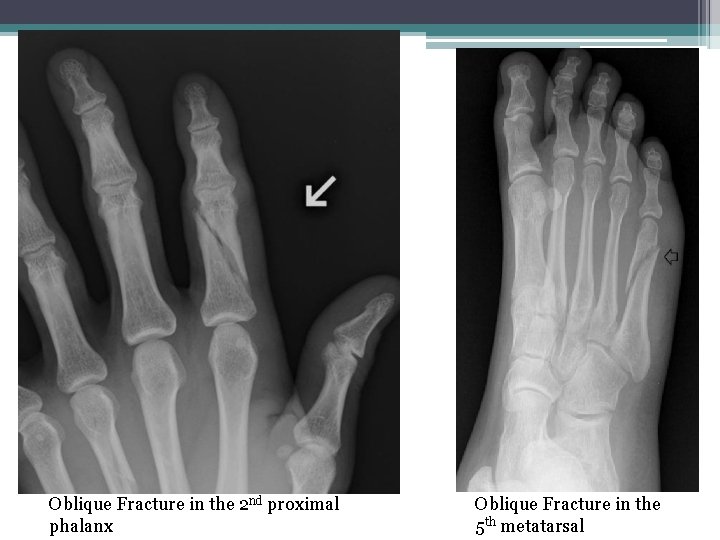 Oblique Fracture in the 2 nd proximal phalanx Oblique Fracture in the 5 th