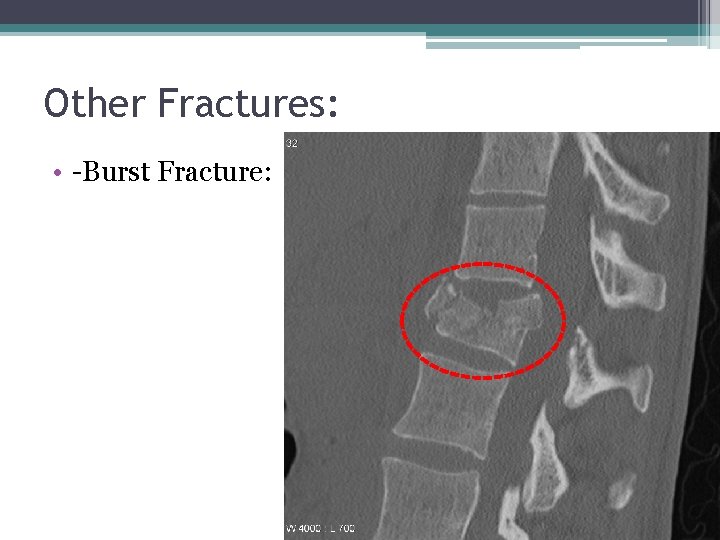 Other Fractures: • -Burst Fracture: 