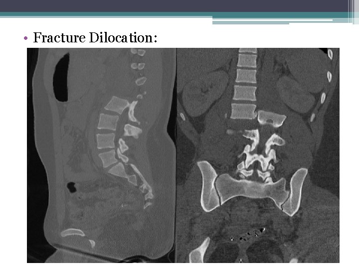  • Fracture Dilocation: 