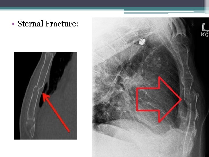  • Sternal Fracture: 