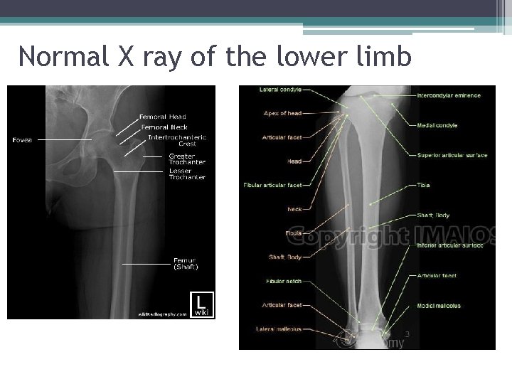 Normal X ray of the lower limb 