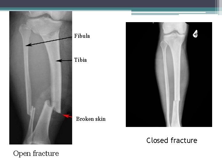 Fibula Tibia Broken skin Closed fracture Open fracture 