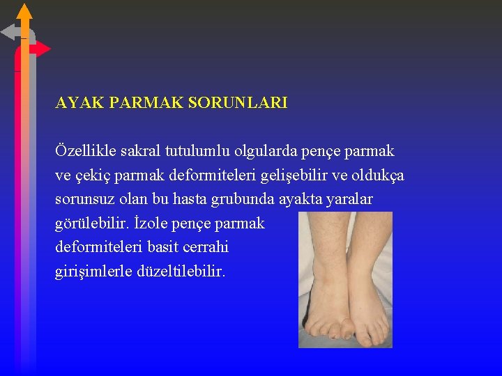 AYAK PARMAK SORUNLARI Özellikle sakral tutulumlu olgularda pençe parmak ve çekiç parmak deformiteleri gelişebilir