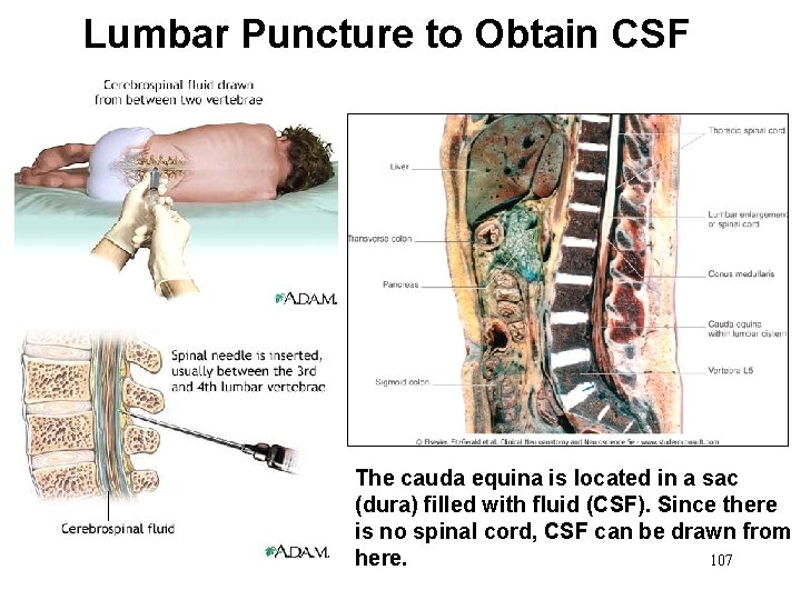Lumbar Puncture to Obtain CSF The cauda equina is located in a sac (dura) Lumbar Puncture to Obtain CSF The cauda equina is located in a sac (dura)