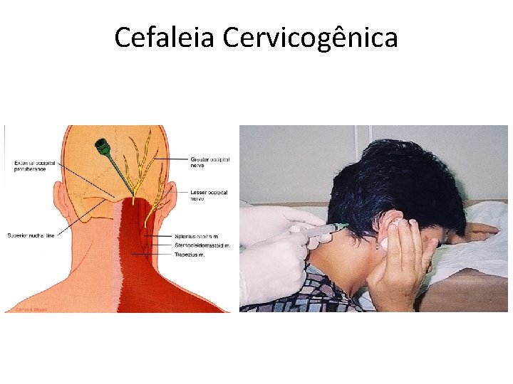 Cefaleia Cervicogênica 