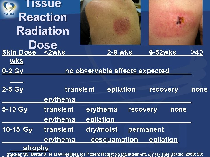 Tissue Reaction Radiation Dose Skin Dose <2 wks 0 -2 Gy 2 -8 wks